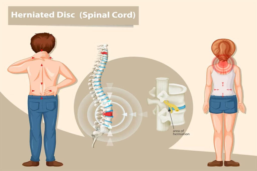 Intervertebral Discs and Spinal Ligaments